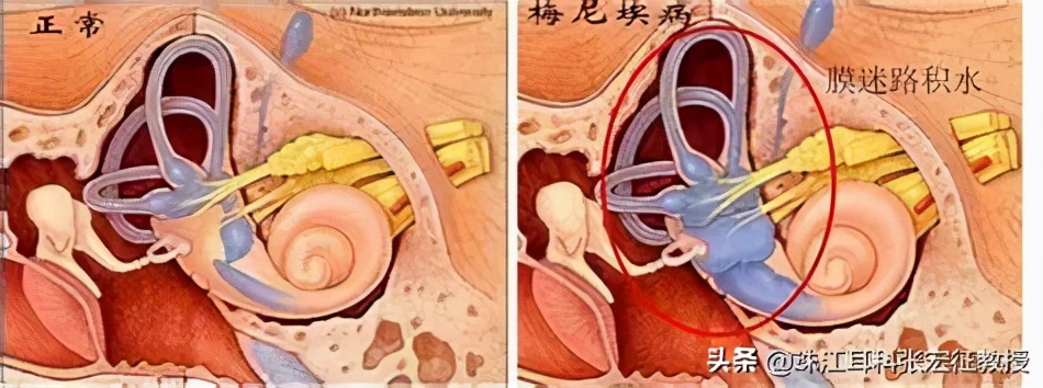青少年耳朵突然耳鸣眩晕听力下降,耳朵听力下降并伴有经常性头晕