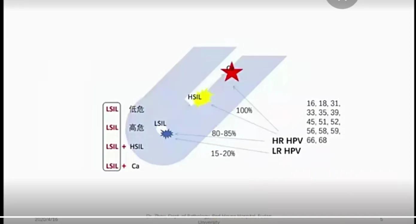 宫颈高级版鳞状上皮内病变指南,宫颈lsil低级别鳞状上皮内病变