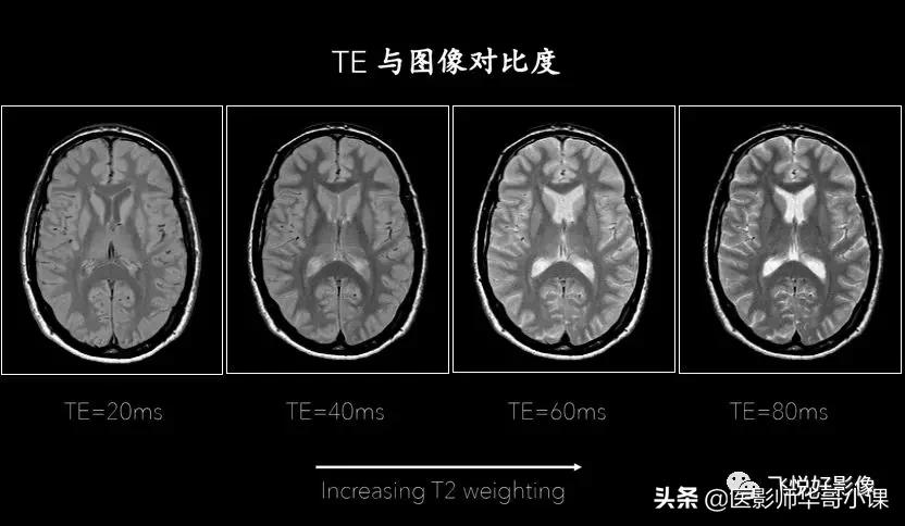 飞利浦磁共振图像操作,飞利浦磁共振成像序列及应用