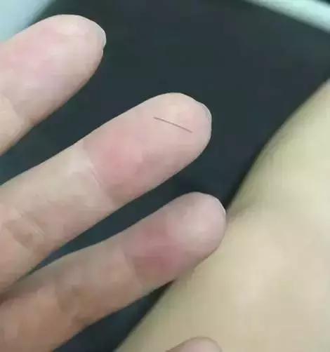 小心！理发的头发碴扎进皮肤，他倒在手术台上