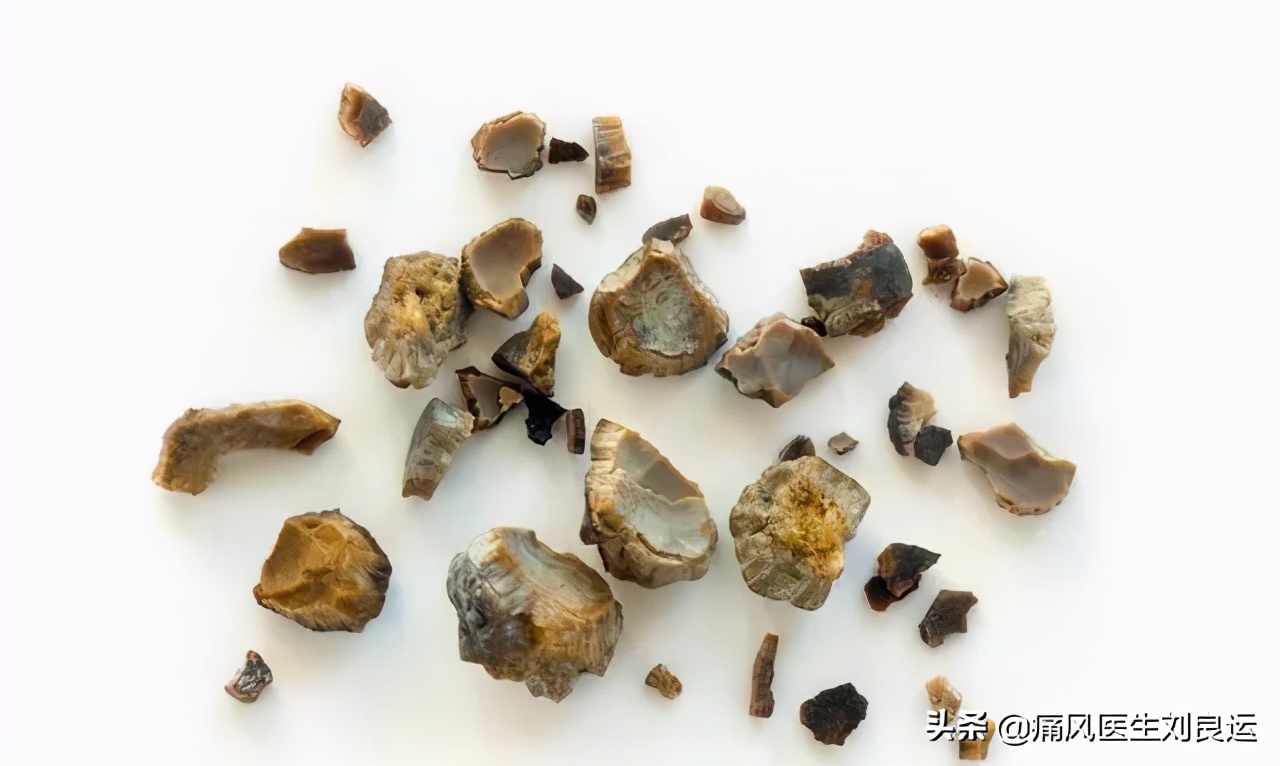 痛风能否真正根治,痛风病可以彻底治疗好吗