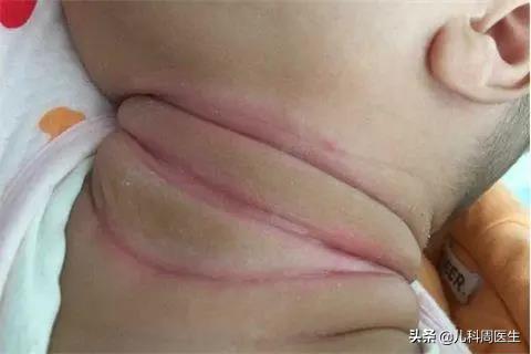 夏日长痱子、淹脖子、湿疹真假难辨？防护做得好，宝宝皮肤自然好