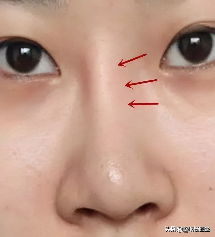 隆鼻失败的常见原因有哪些,隆鼻失败最快的解决方法