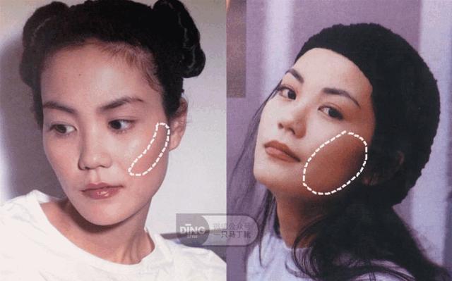 颧骨高太阳穴凹陷怎么改善脸型,颧骨宽大太阳穴凹陷快速改善