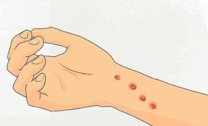 如果猫抓伤了手怎么办,家猫抓伤怎么办最快最有效