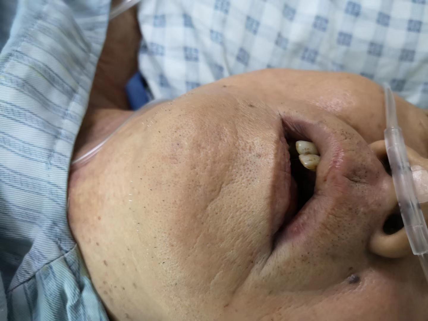 气管插管不拔病人怎么护理,全麻气管插管是从哪里插