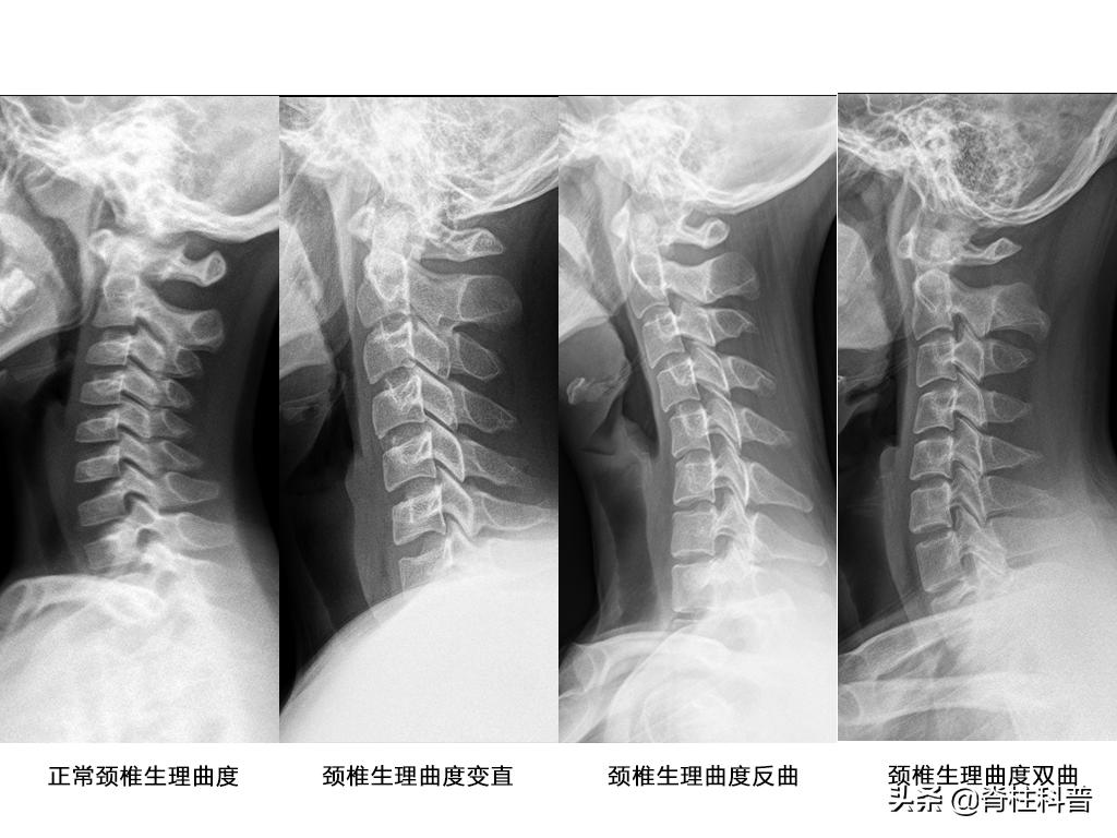 儿童颈椎生理曲度变直头晕头疼,头晕不知道是高血脂还是颈椎病