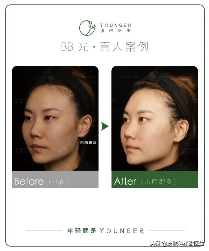 漾肤光子嫩肤,夏天适合做光子嫩肤如何护理