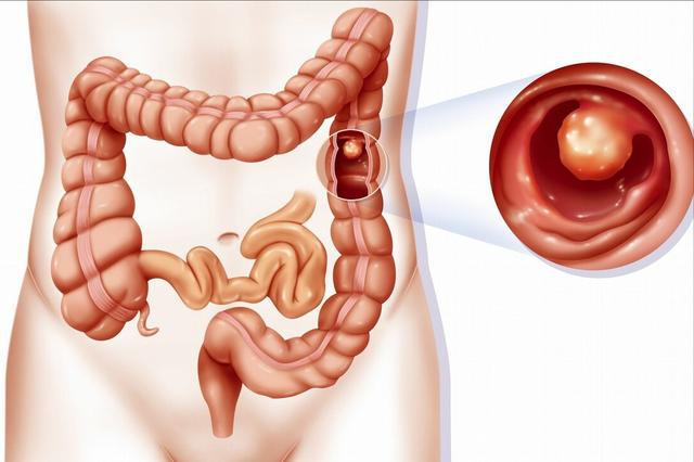 结直肠腺瘤是癌吗？肠腺瘤该如何治疗？