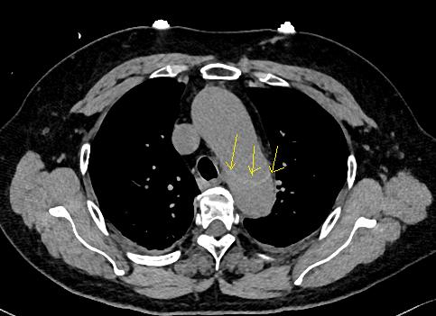 胸部Ct平扫能查出主动脉夹层吗,主动脉夹层cta影像图片解读