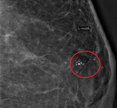 乳房有钙化点忌吃什么,乳房有钙化灶吃什么药好