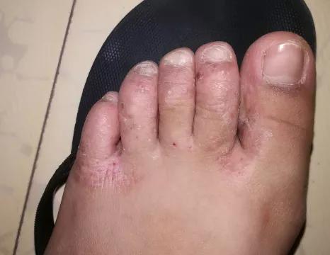 手上脚上起疙瘩又痒又痛咋回事,手上又肿又红又痒又痛还有流脓