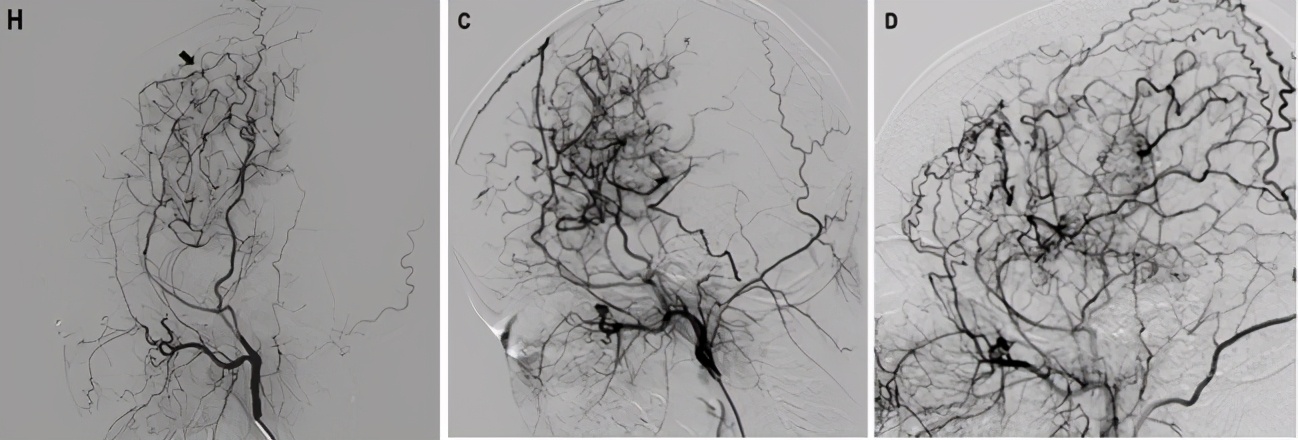 烟雾病的治疗后有疤痕吗,烟雾病的治疗