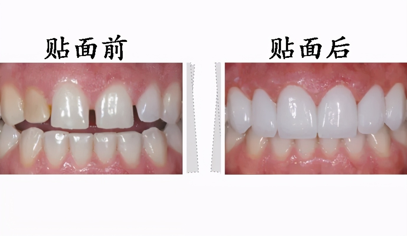 牙齿贴面能修复牙缝大的问题吗,齿科全瓷贴面美白