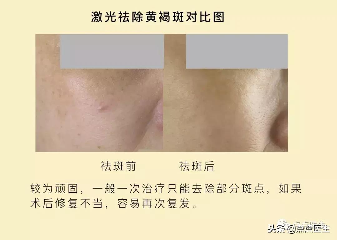 抗衰一定要用医美吗,什么激光抗衰好