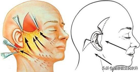 对比常做的几个面部提升项目,祝大夫面部提升