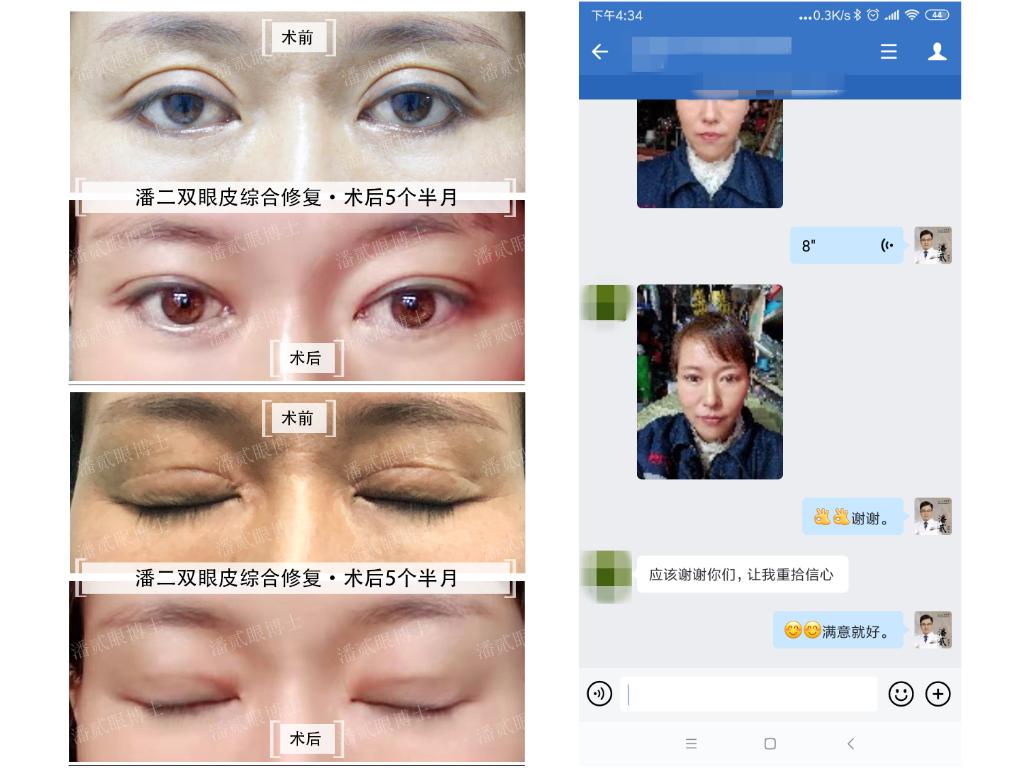 双眼皮修复案例真实,双眼皮修复会越来越糟吗