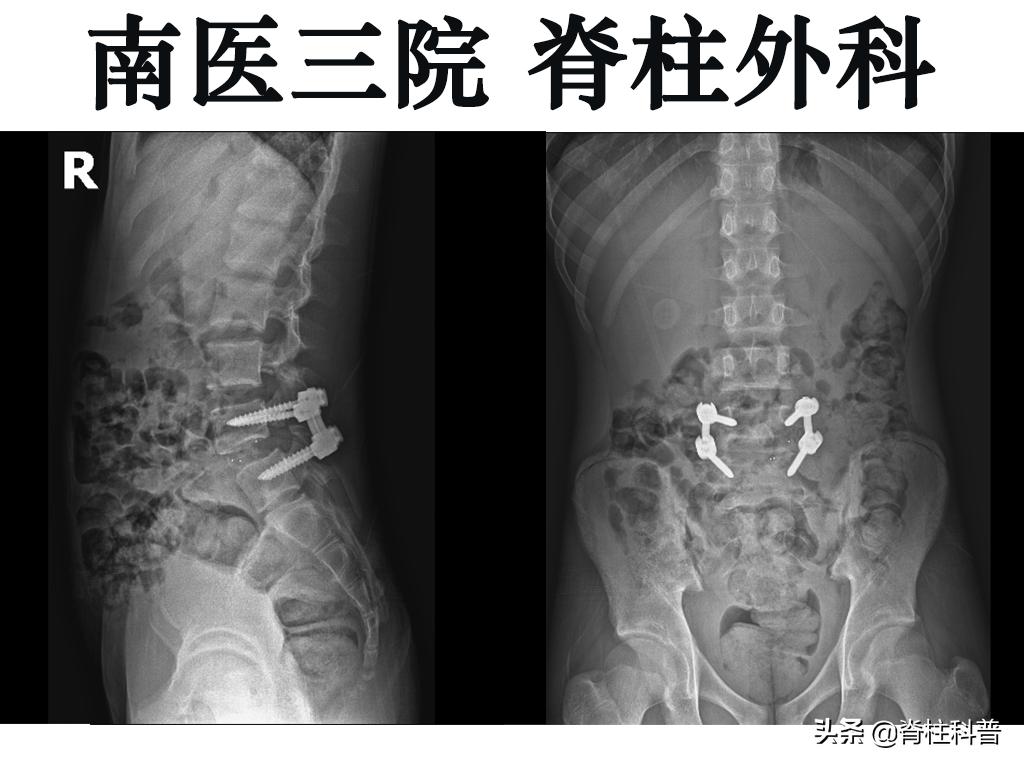 腰痛引起腰椎滑脱怎么治,十七岁腰椎痛怎么办