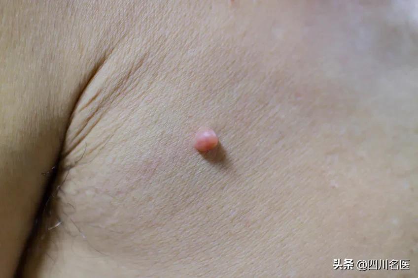 身上突然出现小肉揪,身上的小肉揪是什么