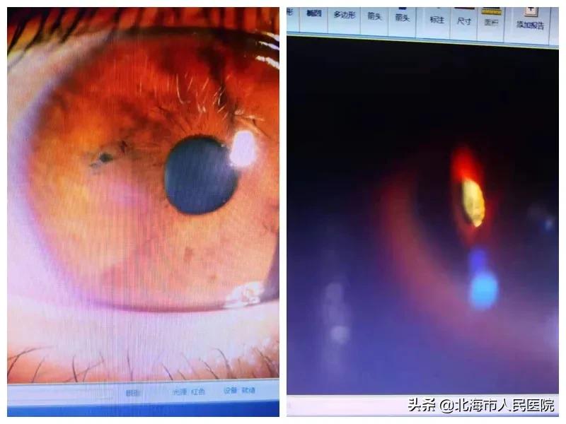 异物入眼划伤眼睛,眼睛进金属异物会失明么