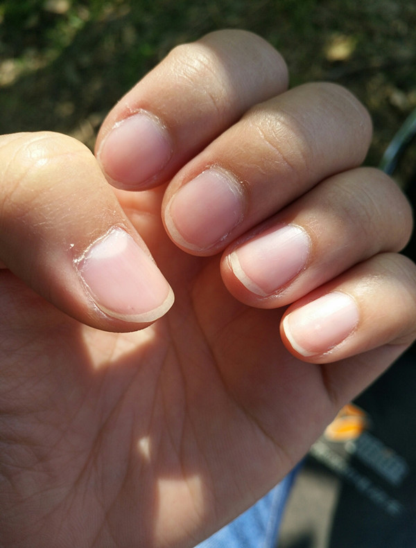 指甲长这样竟是癌症的信号,指甲透露的健康