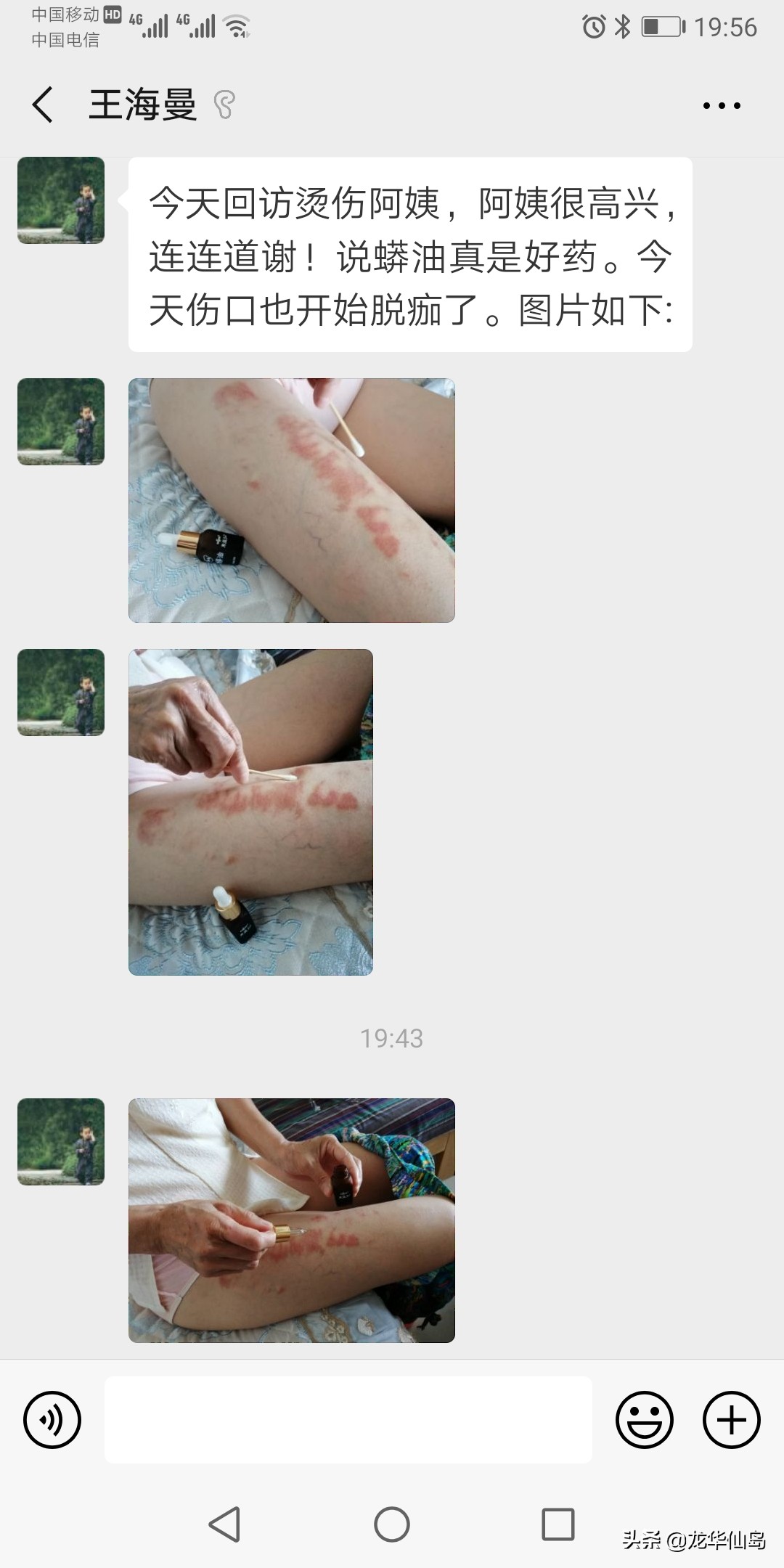 蟒蛇油使用案例与方法