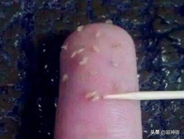 比痘痘更烦人的闭口来了,最有效的去闭口*法大**看过来