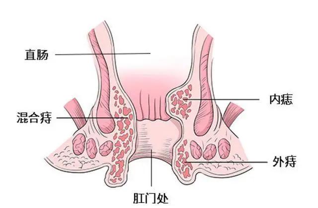 生完孩子后有肉块出来,生完孩子子宫外侧多了块肉是什么