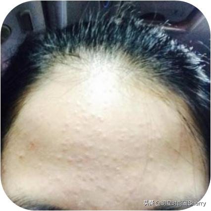 痘痘粉刺护理,痘痘粉刺闭口怎么调养皮肤