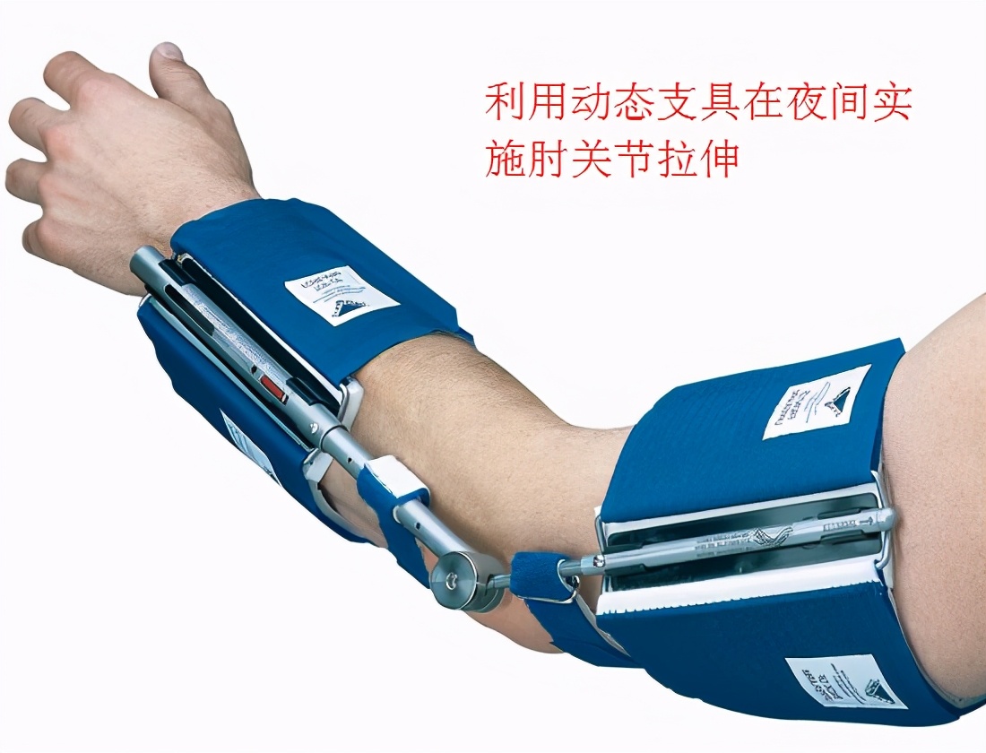 创伤导致肘关节僵硬怎样才能康复,肘关节僵硬松解手术康复训练