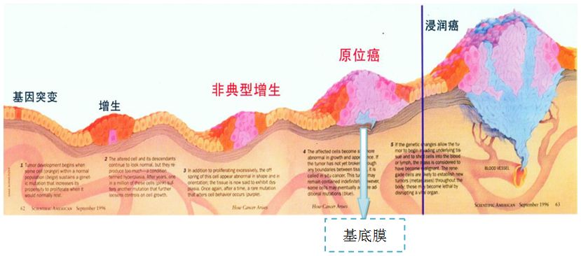 什么是乳腺浸润性癌二级,乳腺浸润癌与原位癌的区别