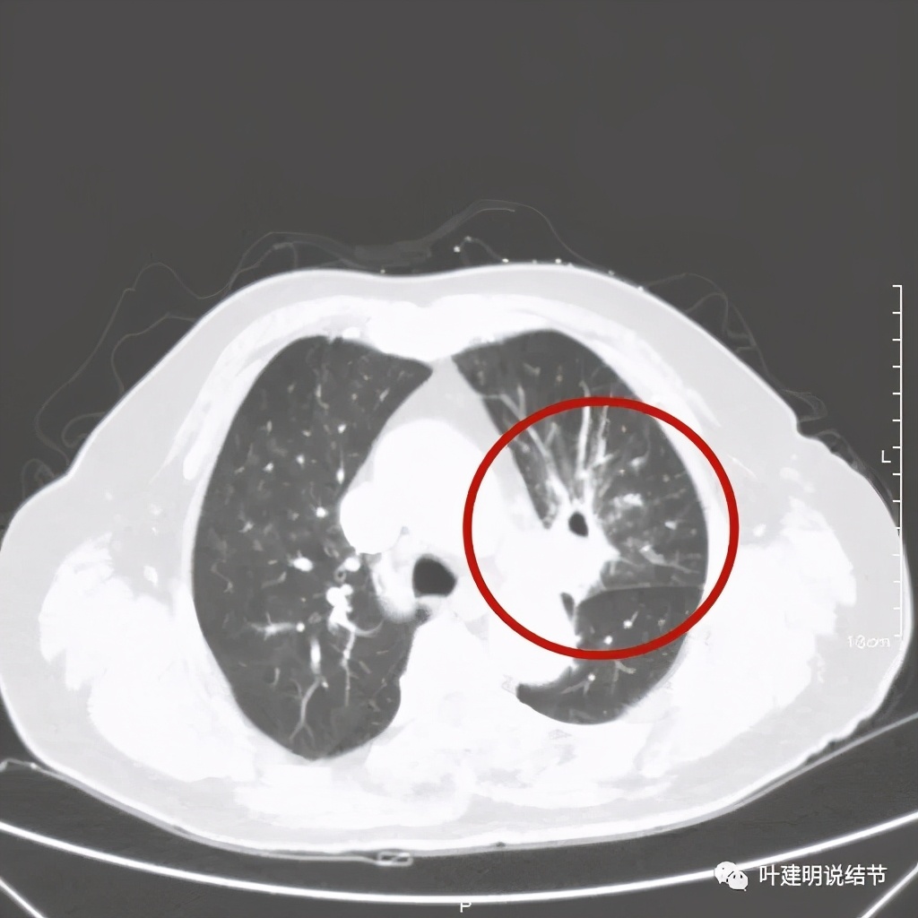 卡瑞利珠单抗治疗肺鳞癌有用吗,特瑞普利单抗对鳞癌治疗有效吗