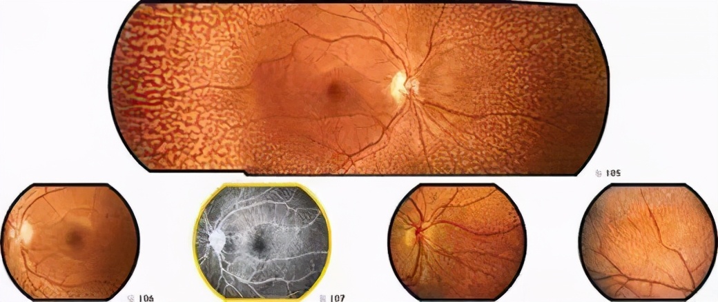 视网膜色素变性是一种常见眼病吗,视网膜色素变性是什么病