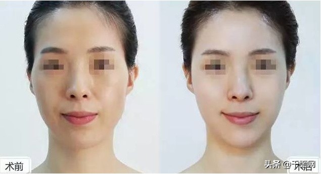 涂抹式太阳穴凹陷填充,40多岁太阳穴凹陷填充