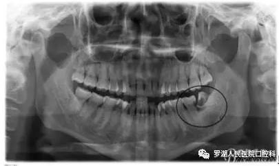 不想拔智齿但很疼怎么办,不想拔智齿想磨掉一部分怎么样