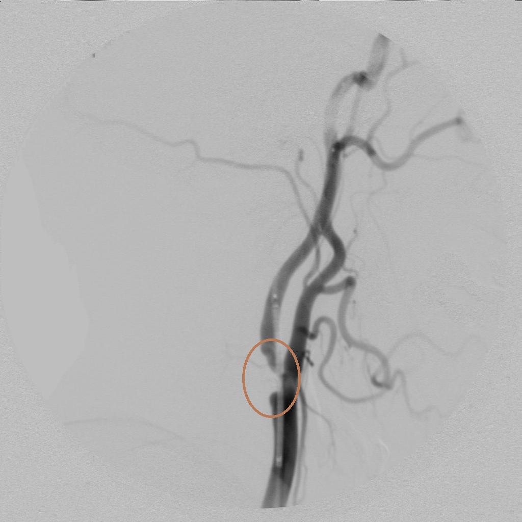 脑卒中超早期康复科普,1分钟了解脑梗