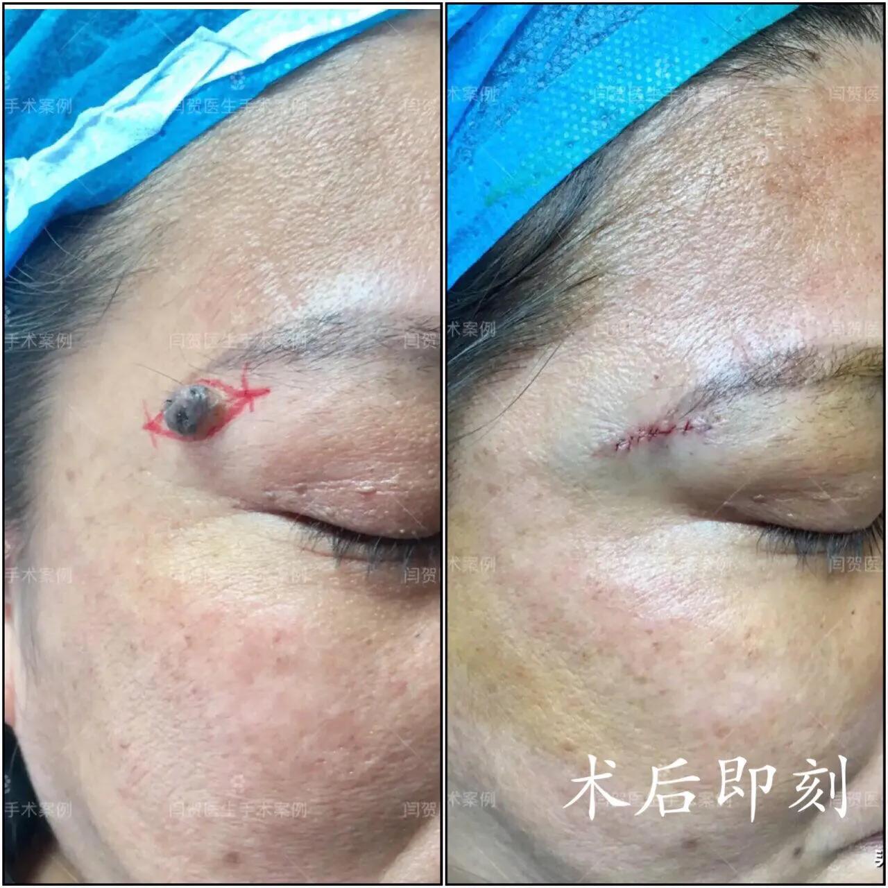 脚底有痣激光还是手术切除,黑色素痣手术切除还是激光去除好