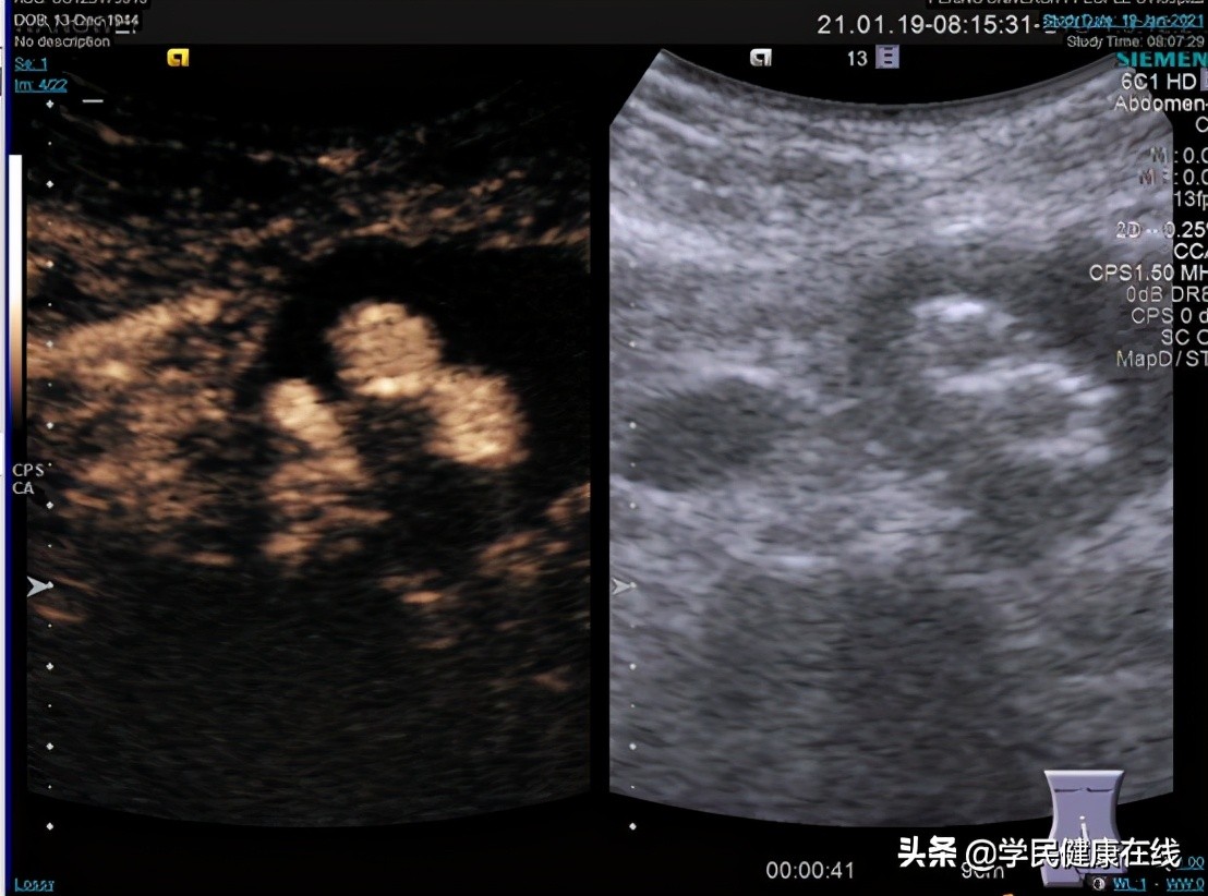 血管外科介入新技术,21世纪血管外科发展方向微创治疗