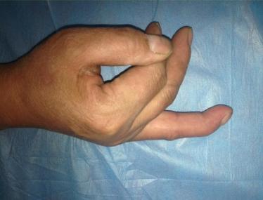 打篮球杵了下手指头,医生告诉要做手术?该不是小题大做吧