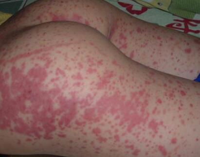 8岁小孩脚有点肿会是肾病吗,小孩双下肢皮疹