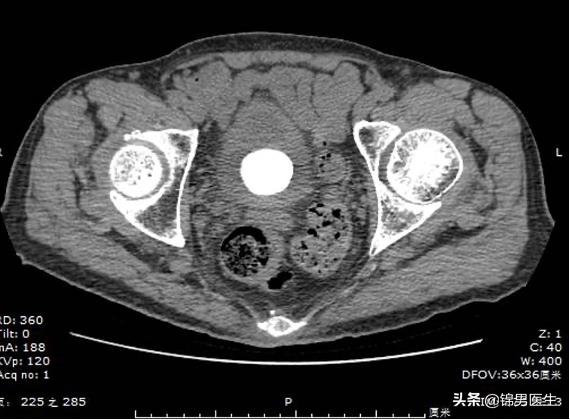男性老年人膀胱结石怎么治疗,老年前列腺排尿困难