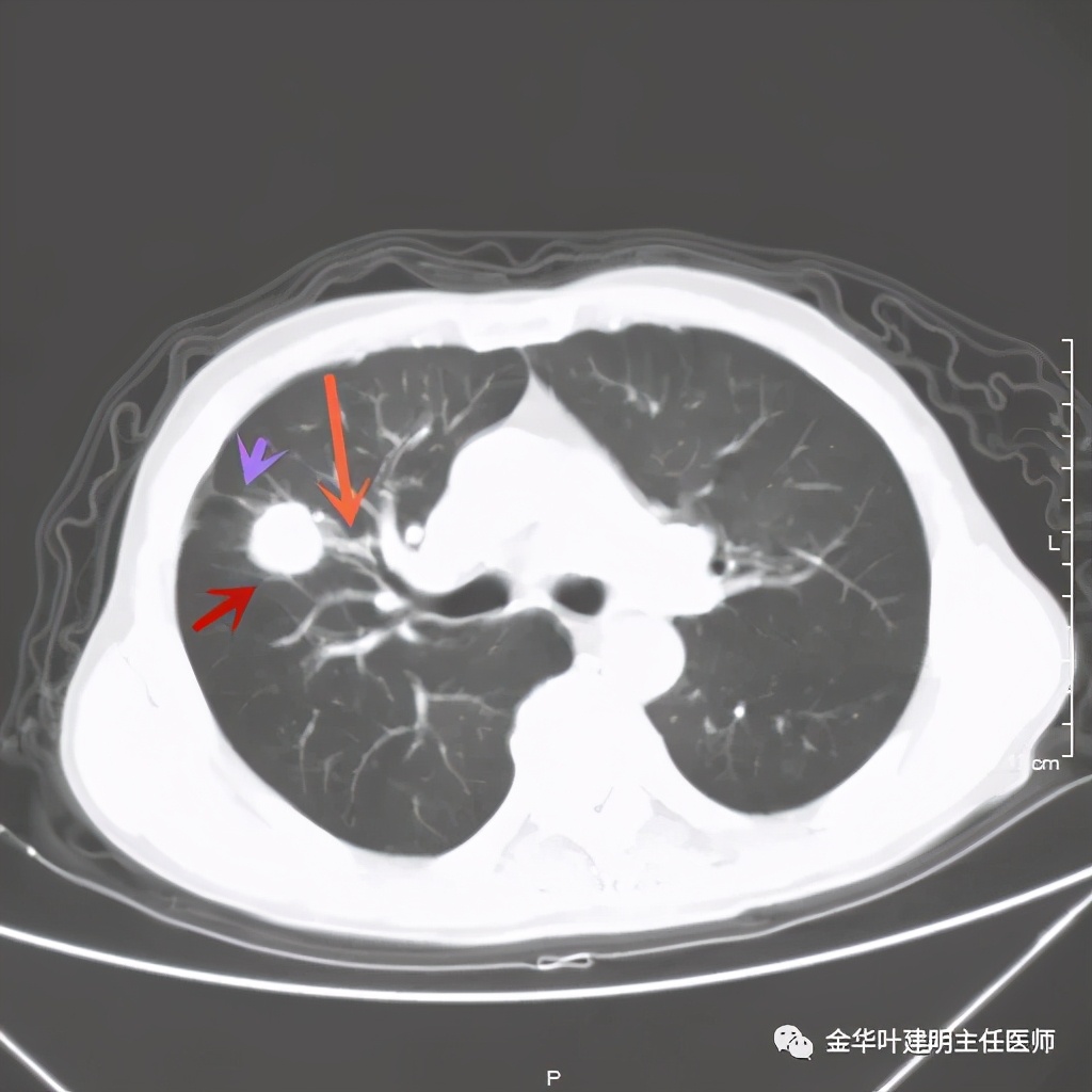 左肺占位被安排穿刺活检是肺癌吗,肺癌肺部穿刺有什么危险