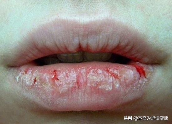 有这3个习惯的女生，最容易变成“香肠嘴”，赶紧改改吧