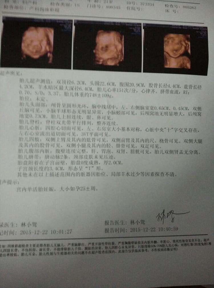 四维胎儿左心室有强光斑严重吗,孕妈四维检测左心室强光点