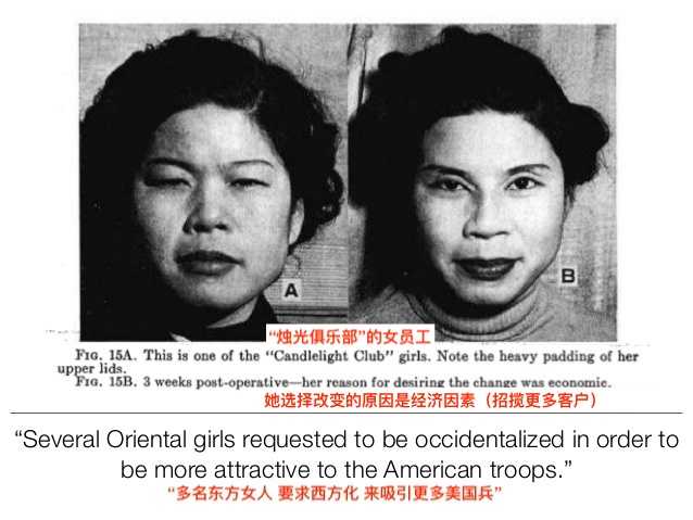 单眼皮肿眼泡割双眼皮多少钱,为什么单眼皮的人喜欢双眼皮