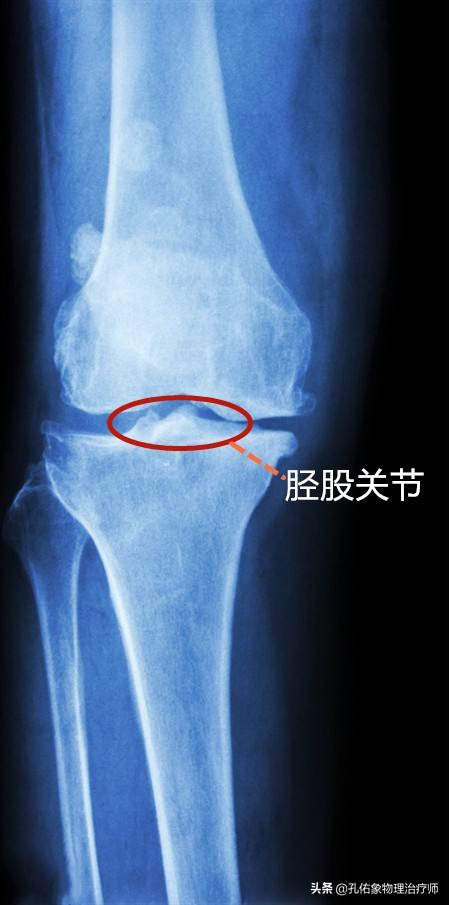 膝盖上下楼梯痛的治疗方法,直腿抬高膝关节弹响疼痛怎么治疗