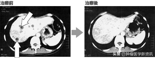 胃癌如何控制复发转移，实现长期生存？辅助治疗是关键！