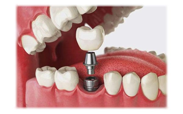 一般看个牙痛多少钱,看个牙包要多少钱