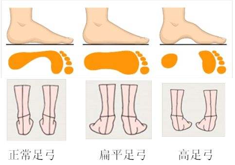 孩子扁平足没有足弓怎么办,儿童足弓偏低扁平足患病率较高
