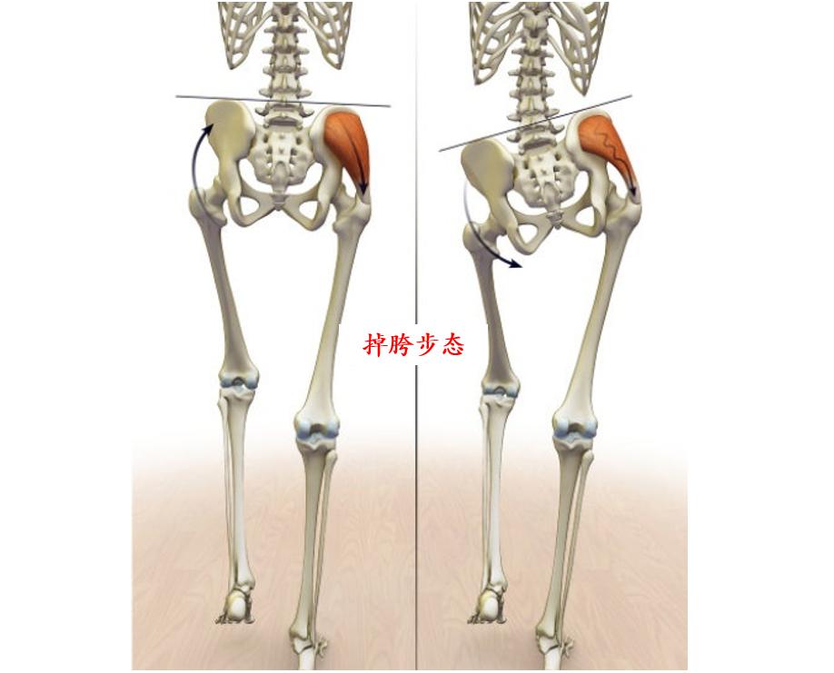 大腿特别粗怎么减,大腿粗怎么办教你一招解决